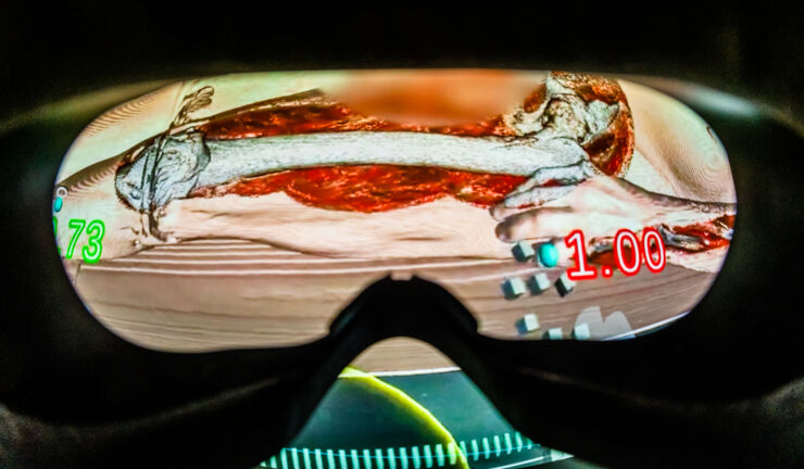Digital autopsy seen through hololens.