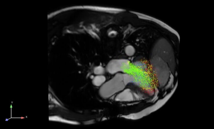 Skärmdump av 4D-flödes-MRI som visar flöde i hjärta