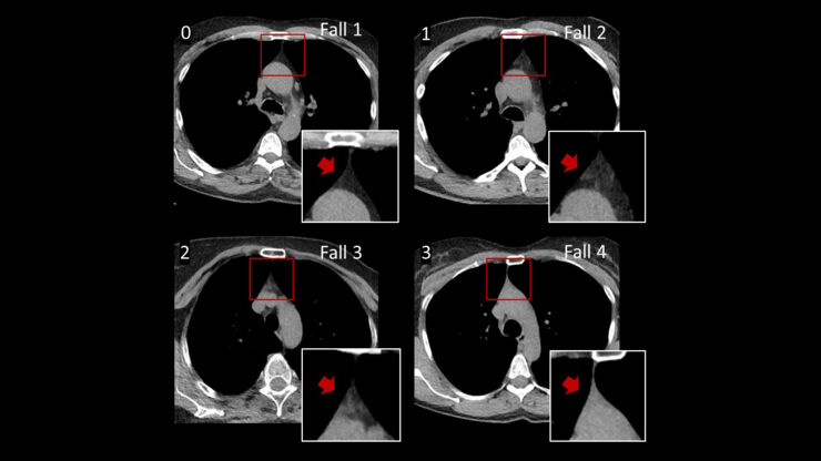 datortomografibilder som visar olika grader av fett i thymus.