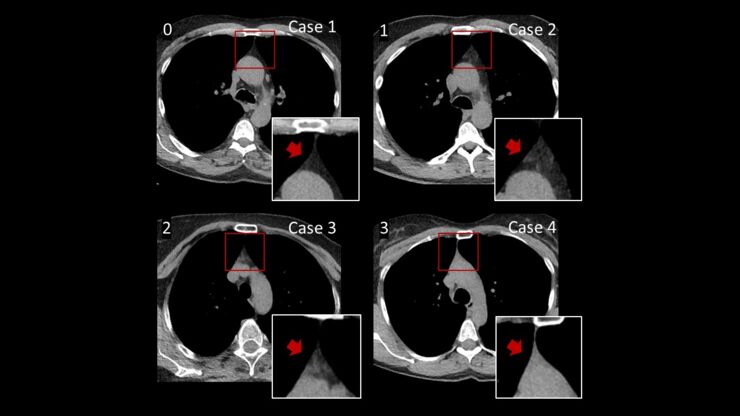 CT images of different grades of fat degeneration of thymus.