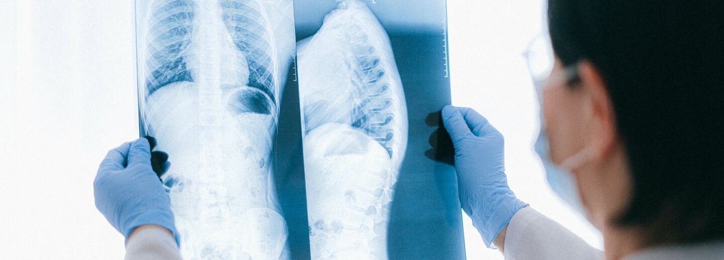 En röntgenbild hålls upp av två händer med blåa handskar.