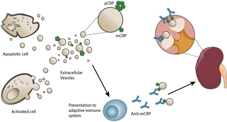 Graphical Abstract from the publication: Extracellular vesicles opsonized by monomeric C-reactive protein (CRP) are accessible as autoantigens in patients with systemic lupus erythematosus and associate with autoantibodies against CRP