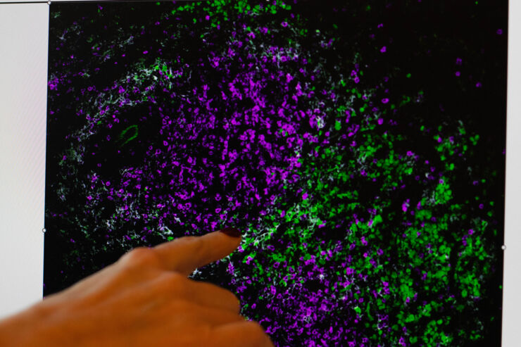 Judit pekar på en konfokalmikroskopibild som visar T-celler (som färgats magenta) som infiltrerat tumörvävnaden (där tumörceller är märkta med det grön-fluorescerande proteinet GFP) efter behandling med immunterapi med onkolytisk virus.