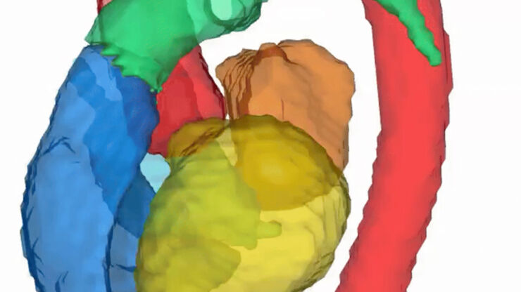 Tidsupplöst segmentering av kardiella strukturer såsom kammare, förmak och aorta. Framtaget från en MR-undersökning genom att använda en utvecklad AI-algoritm. 