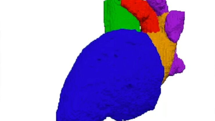 Time-resolved segmentation of cardiac structures such as the left ventricle, left atrium and left atrial appendage. Acquired from a CT-examination by using an in-house developed AI-algorithm. 