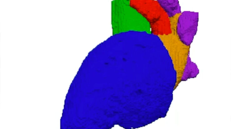 Tidsupplöst segmentering av kardiella strukturer såsom vänster kammare, vänster förmak och vänster förmaksöra. Framtagen från en DT-undersökning genom att använda en utvecklad AI-algoritm. 