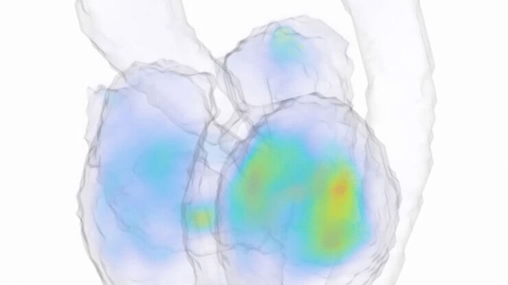 Visualisering av kinetisk energi i hjärtat och aorta. Datasetet är framtaget genom en MR-undersökning. 