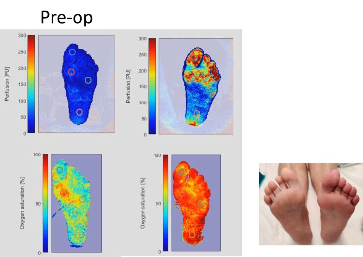 Sketch how algorithms can help support the treatment of diabetic foot ulcers.