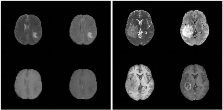 The image consists of two parts: four sections views of a brain on the one side and fous sections of another brain on the other side
