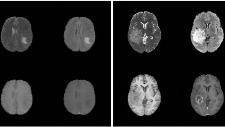 The image consists of two parts: four sections views of a brain on the one side and fous sections of another brain on the other side