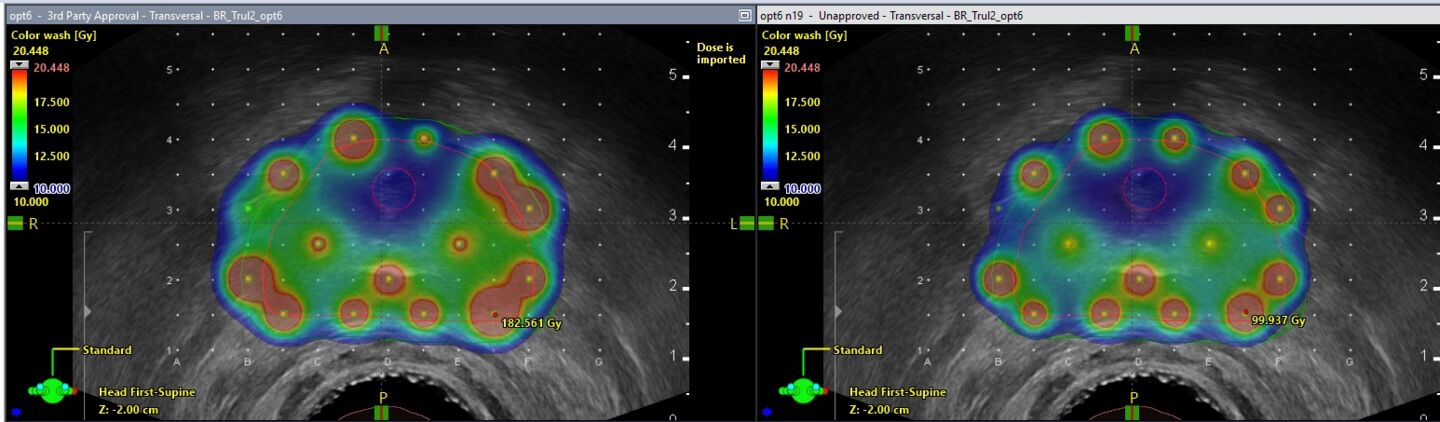 Brachytherapy Treatment Planning-