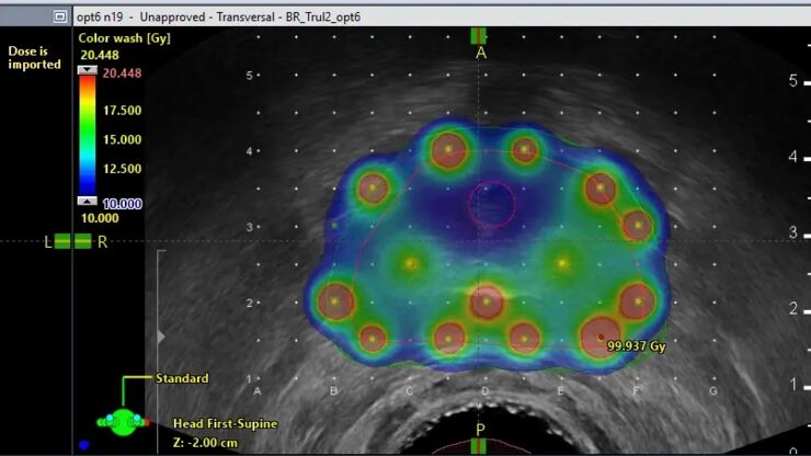 Brachytherapy Treatment Planning-