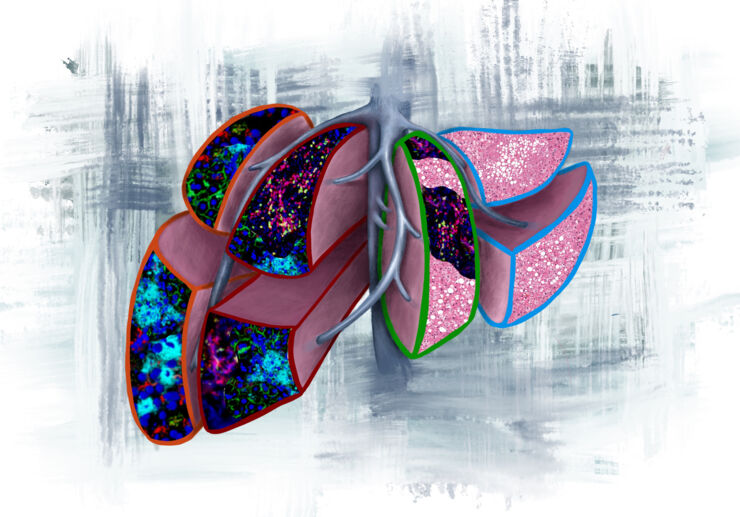 Illustration av levern, som illustrerar fynden i studien. I de olika delarna ser vävnaden olika ut, och visar egenskaper som skiljer sig åt mellan patientgrupperna. 
