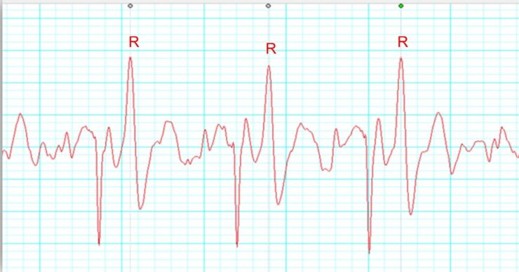 Electrocardiogram of a dolphin showing the R-R intervals.