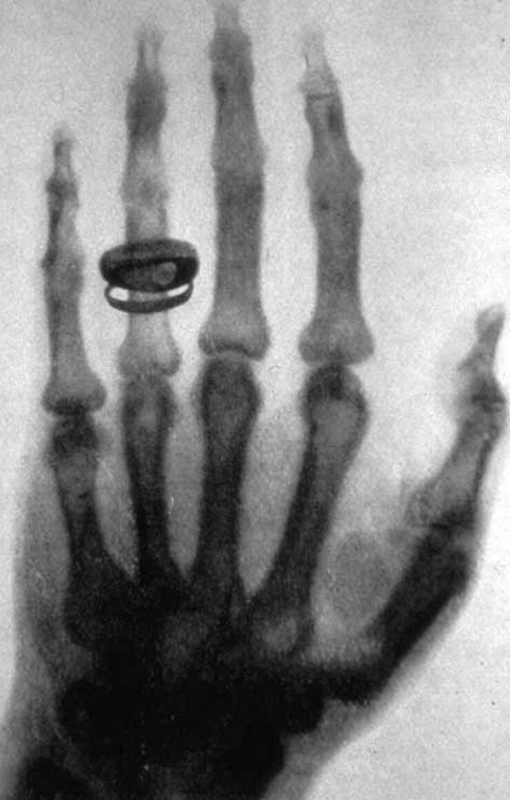 X-ray image of hand. 